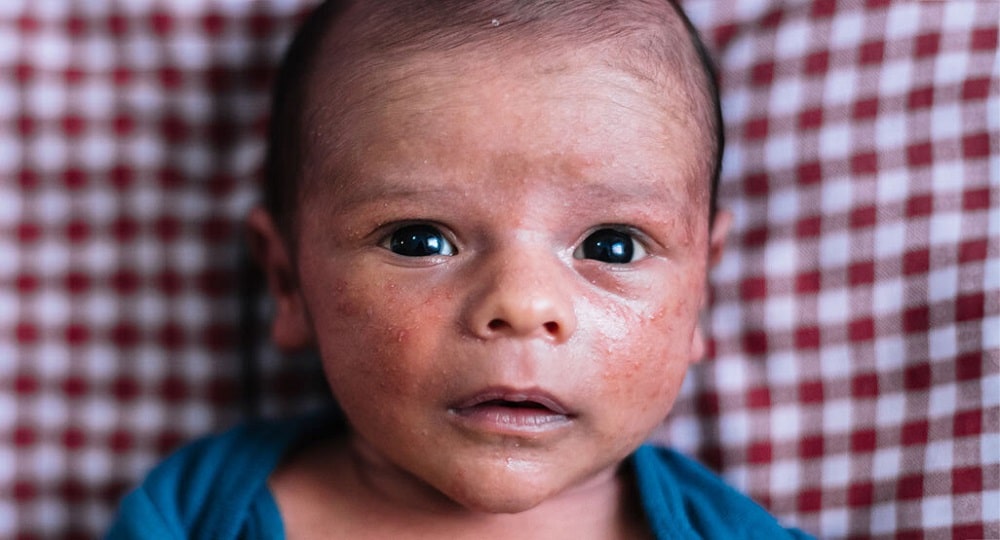 چه چیزی باعث آکنه نوزاد می‌شود؟