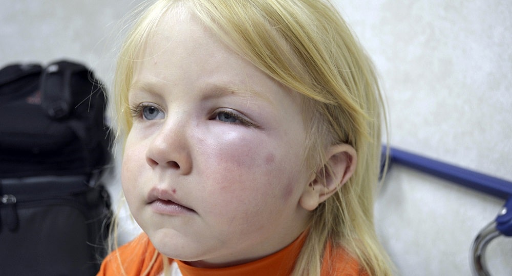 آنافیلاکسی در نوزادان و کودکان