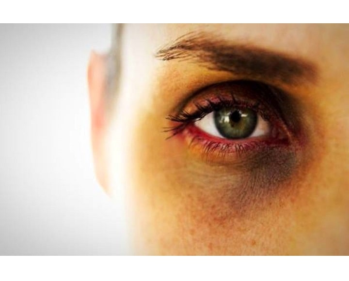 علل تیرگی دور چشم